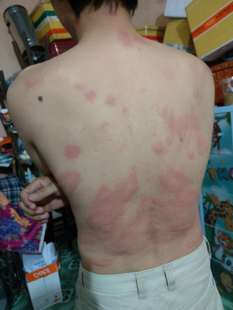 Chứng ngứa từ trong máu? Chứng ngứa từ trong máu?