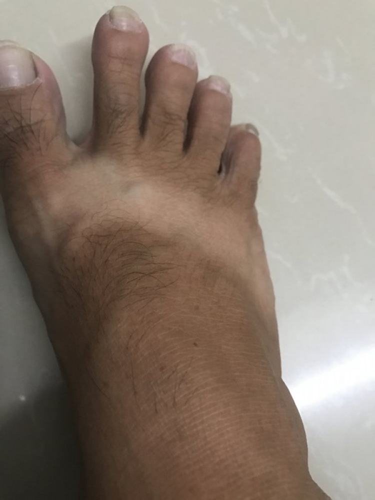 chữa bệnh mồ hôi chân chữa bệnh mồ hôi chân