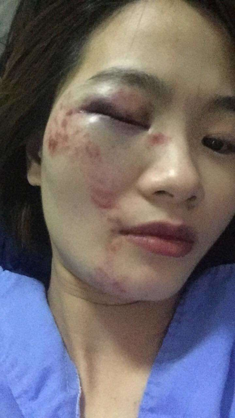 Nữ nhân viên xe buýt bị đánh đến nhập viện vào ngày quốc tế phụ nữ