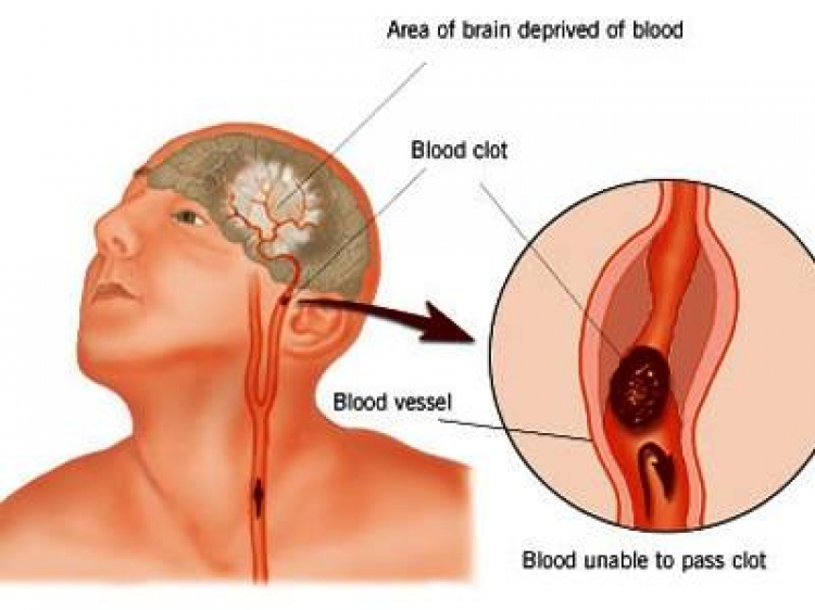 (nâng dân trí CNL) MÌ ĂN LIỀN GÂY ĐỘT QUỴ, UNG THƯ, CAO HUYẾT ÁP VÀ HỎNG THẬN!