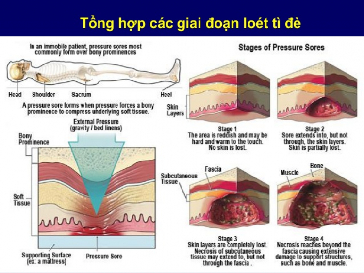 cách chăm sóc người nằm liệt bị loét tỳ đè