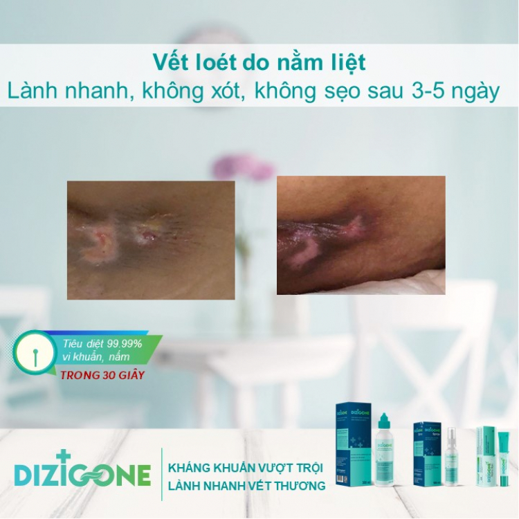 cách chăm sóc người nằm liệt bị loét tỳ đè cách chăm sóc người nằm liệt bị loét tỳ đè