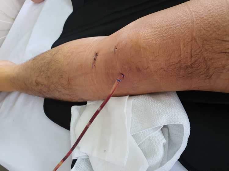 Hồi phục sau mổ dây chằng chéo trước Hồi phục sau mổ dây chằng chéo trước