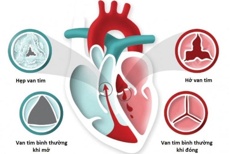 Bệnh hở van 2 lá có những triệu chứng lâm sàng nào ?